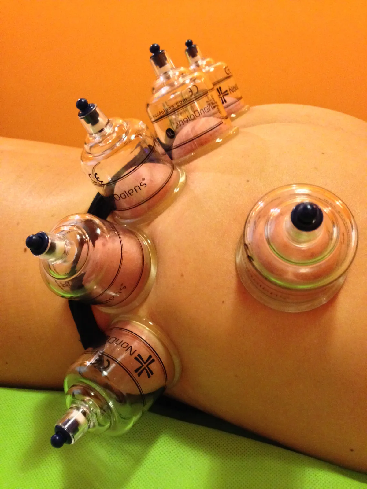 Köpölyözés - mély vákum eszközök bemutatása